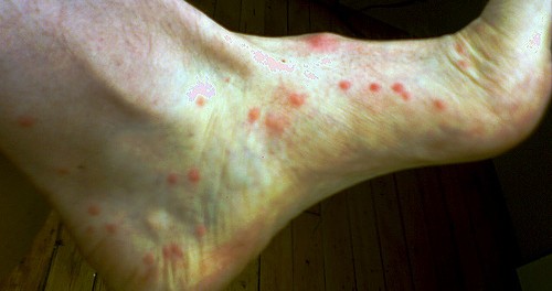 Flea Bites Picture Image on MedicineNet.com